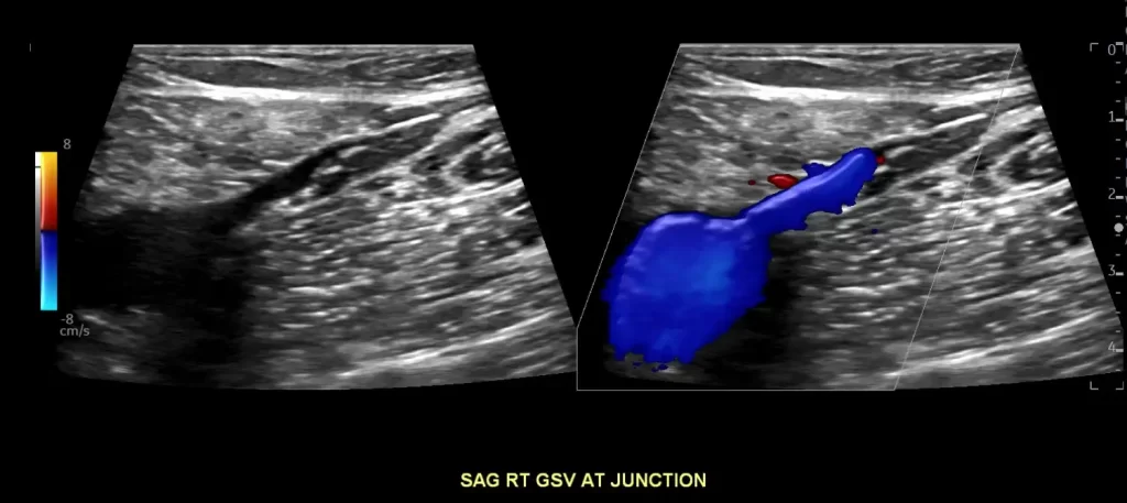 superficial thrombophlebitis