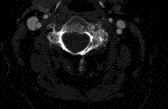 clot in a neck artery CT