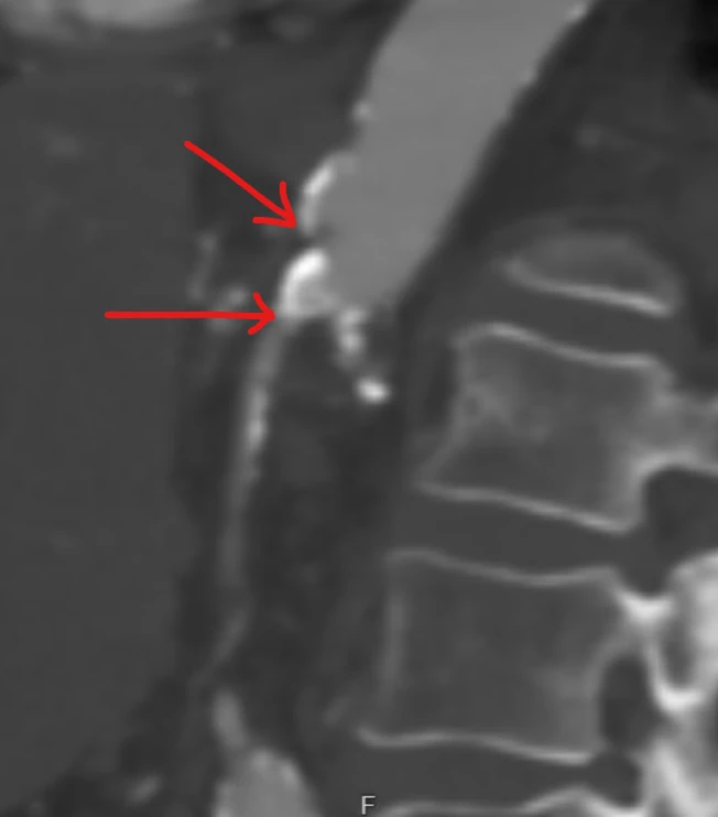chronic mesenteric ischemia CT