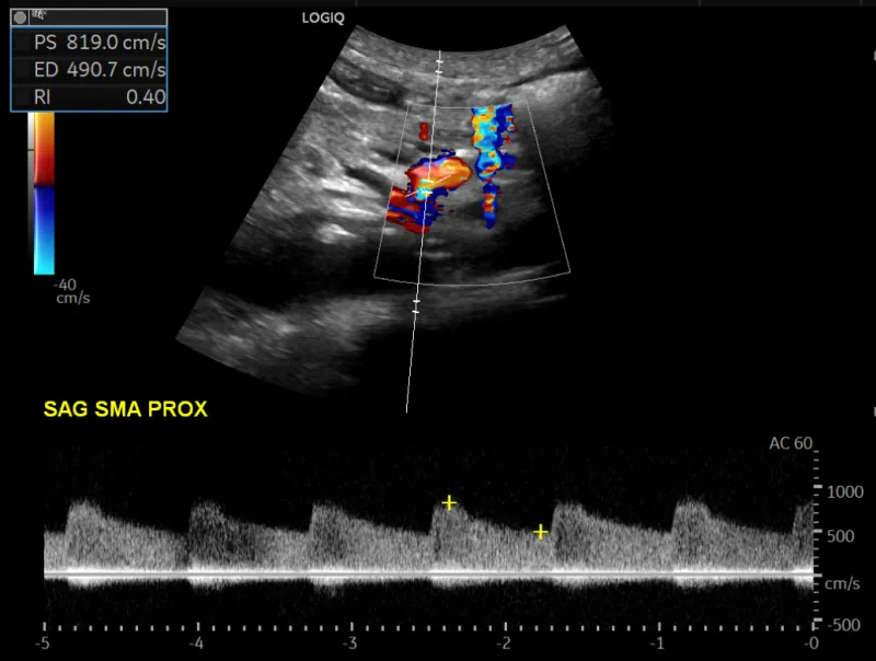 chronic mesenteric ischemia