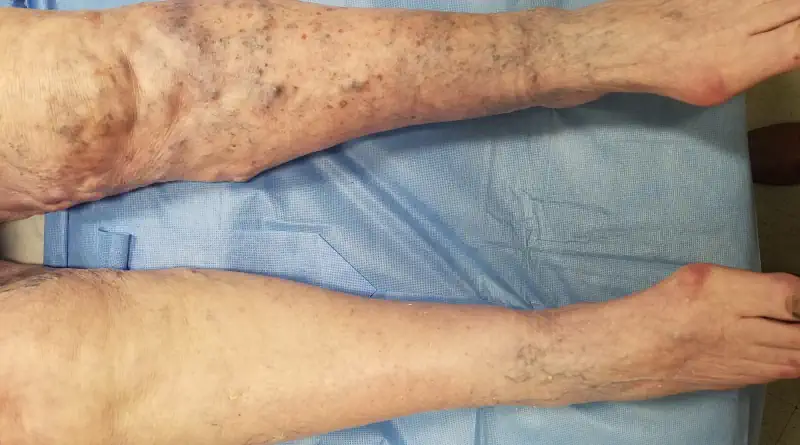 varicose veins and thrombosis