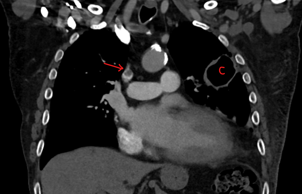 cancer and blood clots