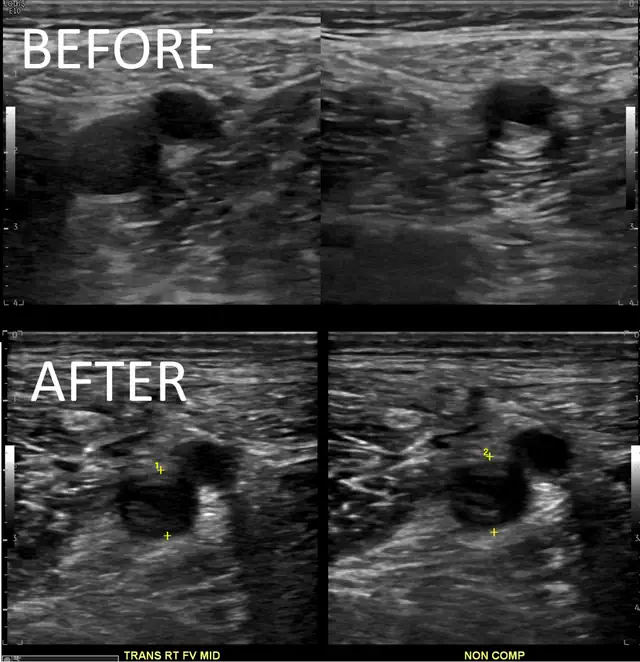 anticoagulation failure
