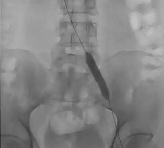 May Thurner treatment